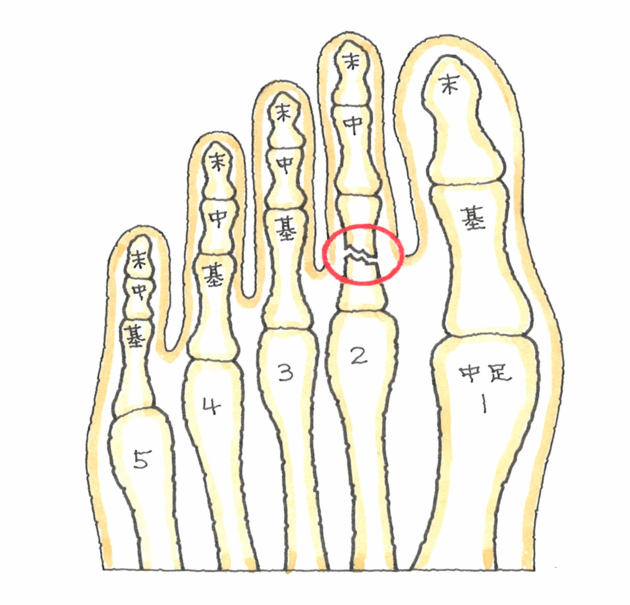 ブログ 足趾の骨折 基節骨の骨折 熊本の弁護士 交通事故のトラブル弁護は田中ひろし法律事務所